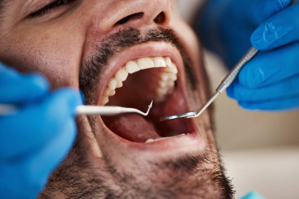 Best Dentist for Tooth Abscess  in Roanoke, AL
